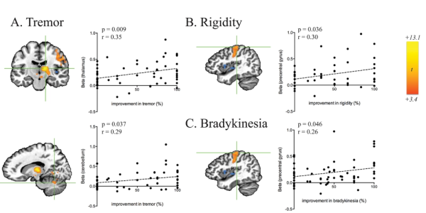 Brain Stimulation